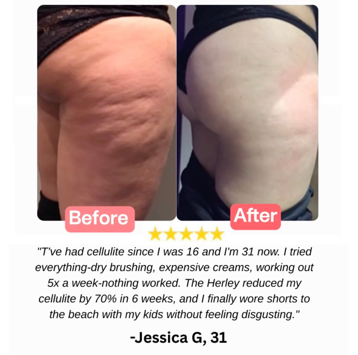 The Herley™ Lymph Blade